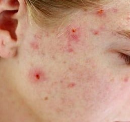 The image of a face of a teenage girl  covered by acne. 
