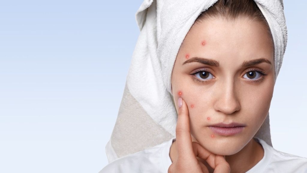 a picture of a young woman pointing her acne with her finger to discuss about how to remove acne scar