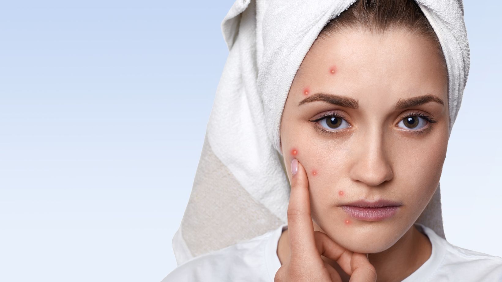 How can I remove Acne scars? Beauty care code