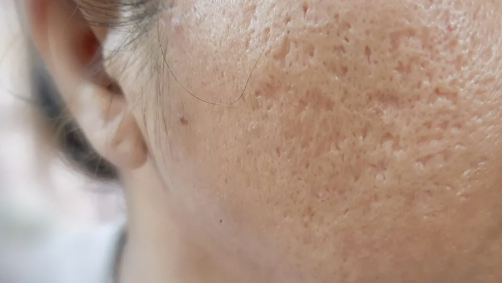 An image of a side of a face with depressed scars left behind acne